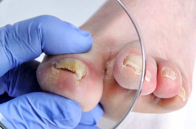 Mom's Toenails Are Gross!